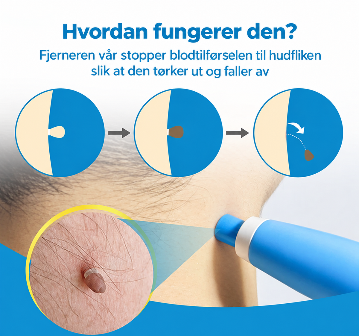 Hudflikfjerner